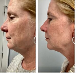 sofwave before and after