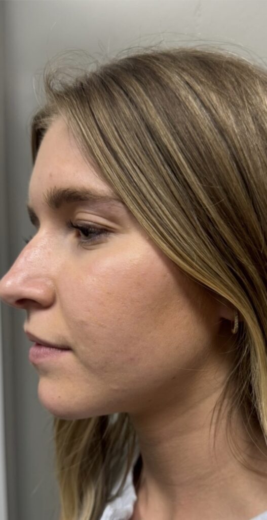 10 week transformation with BBL ForeverClear and ZO skincare