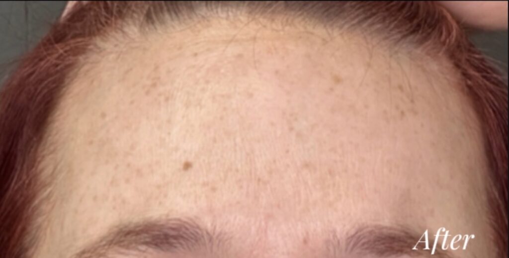 Neurotoxins in Forehead